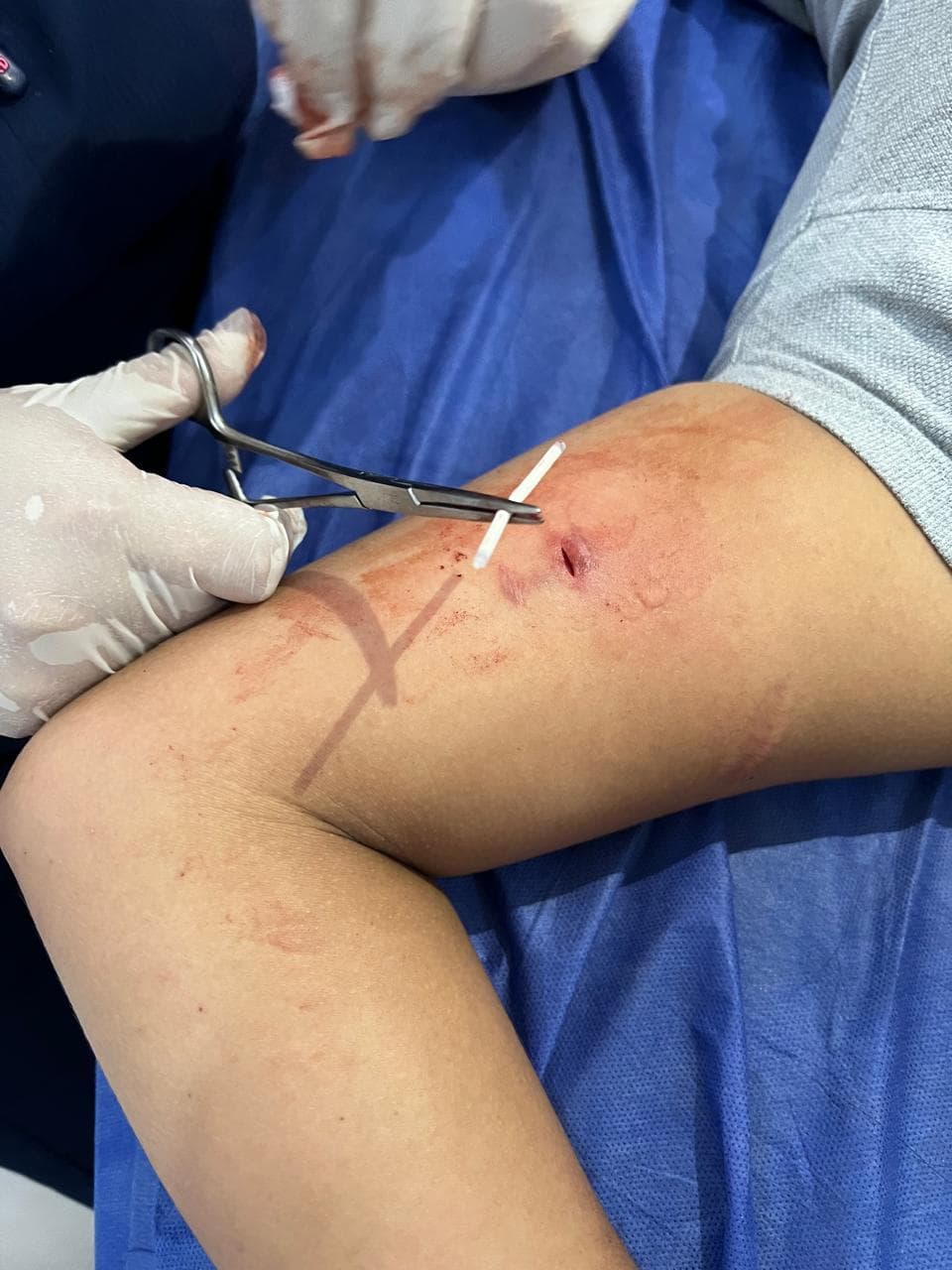 Sutura y Retiro de Puntos